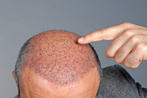 Hair Transplant for Busy Professionals: Recovery and Daily Care Tips 1 Hair Transplant for Busy Professionals: Recovery and Daily Care Tips