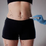How to Choose the Right Liposuction Procedure for Your Body