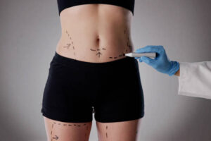 How to Choose the Right Liposuction Procedure for Your Body 1 How to Choose the Right Liposuction Procedure for Your Body
