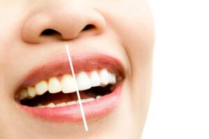 How Professional Teeth Whitening Is Planned for Natural Results 1 How Professional Teeth Whitening Is Planned for Natural Results