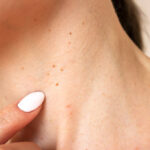 Skin Tag Removal in Dubai 14