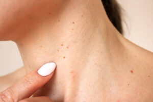 Where to Find Trusted Skin Tag Removal in Dubai Care