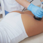 Thigh Lift in Dubai 4