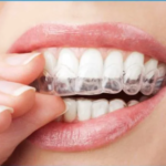 Self Ligating Braces Philippines: A Modern Solution for a Straighter Smile