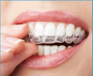 Self Ligating Braces Philippines: A Modern Solution for a Straighter Smile