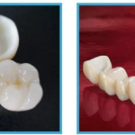Dental Crowns Philippines: Restore Strength and Beauty to Your Smile