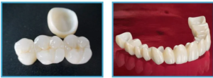 Dental Crowns Philippines: Restore Strength and Beauty to Your Smile