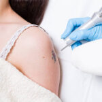 Laser Tattoo Removal and Sun Exposure: What You Need to Know