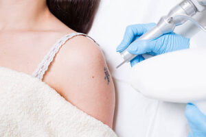 Laser Tattoo Removal and Sun Exposure: What You Need to Know