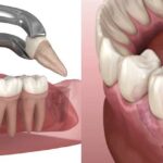 Best Root Canal Treatment vs Tooth Extraction: Which Is Better?