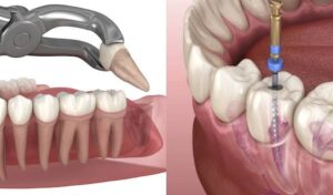 Best Root Canal Treatment vs Tooth Extraction: Which Is Better? 1 Best Root Canal Treatment vs Tooth Extraction: Which Is Better?