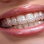 What Affects the Cost of Braces Treatment in Parel Mumbai?