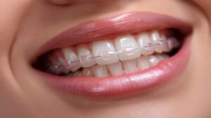 What Affects the Cost of Braces Treatment in Parel Mumbai? 1 What Affects the Cost of Braces Treatment in Parel Mumbai?