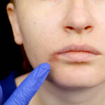 Top Facial Scar Revision in Dubai Options for Scar Treatment 3 Top Facial Scar Revision in Dubai Options for Scar Treatment