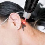 Laser Tattoo Removal in Riyadh 10