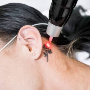 Laser Tattoo Removal in Riyadh for Restoring Skin Beauty Naturally