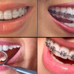 Benefits of Teeth Braces and Why Orthodontic Treatment in India Makes Sense