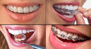 Benefits of Teeth Braces and Why Orthodontic Treatment in India Makes Sense