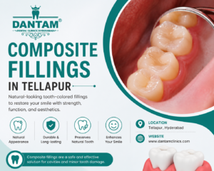 Composite Fillings in Tellapur: A Natural Solution for Healthy, Beautiful Smiles 1 Composite Fillings in Tellapur: A Natural Solution for Healthy, Beautiful Smiles