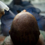 Hair Transplant Success Rate: What Affects the Results?