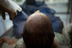 Hair Transplant Success Rate: What Affects the Results?