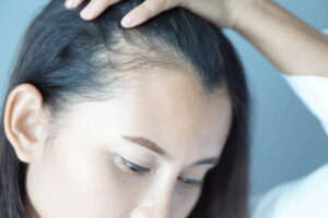 Hair Loss Treatment in Riyadh for Restoring Scalp and Hair Wellness 1 Hair Loss Treatment in Riyadh for Restoring Scalp and Hair Wellness