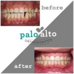 Exploring Modern Treatment Options for Healthier, Straighter Smiles 3 Exploring Modern Treatment Options for Healthier, Straighter Smiles