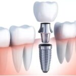 Are Dental Implants Permanent? Lifespan, Durability & Care Explained
