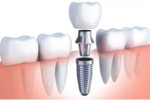Are Dental Implants Permanent? Lifespan, Durability & Care Explained