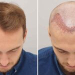 Hair Transplant in Kondapur: What Every Patient Should Know Before Deciding