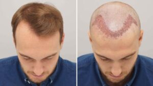 Hair Transplant in Kondapur: What Every Patient Should Know Before Deciding