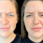 Botox Treatment in Dubai: Who Is the Ideal Candidate?