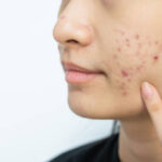 Common Mistakes to Avoid After Acne Scar Treatment
