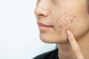 Common Mistakes to Avoid After Acne Scar Treatment