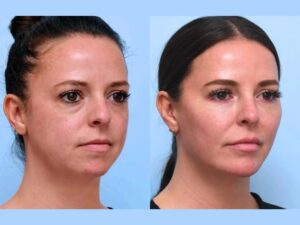 Thread lift treatments in Dubai Supporting Smooth Natural Looking Facial Contours