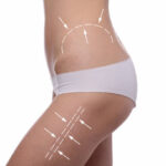 Body Contouring Treatment 5