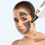 The Ultimate Guide to Spectra Laser Carbon Peeling for Radiant Skin 3 The Ultimate Guide to Spectra Laser Carbon Peeling for Radiant Skin