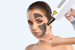 The Ultimate Guide to Spectra Laser Carbon Peeling for Radiant Skin