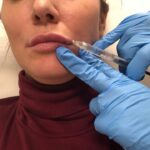 restylane dubai7