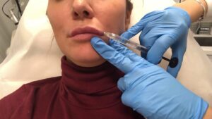Why Is Restylane a Popular Choice for Facial Fillers? 1 Why Is Restylane a Popular Choice for Facial Fillers?