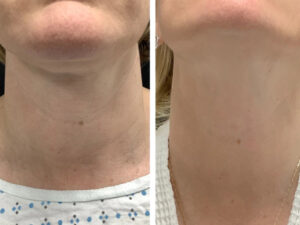 Best Doctors in dubai for Radiofrequency Microneedling Facial Rejuvenation