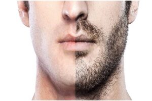 What to Expect During a Beard Transplant in Dubai 1 What to Expect During a Beard Transplant in Dubai