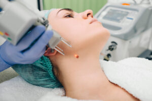 Professional Insights on Laser Acne Scar Treatment in Riyadh Techniques 1 Professional Insights on Laser Acne Scar Treatment in Riyadh Techniques