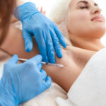 How MiraDry Treatment Targets Sweat Glands Without Surgery