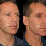 Best Aesthetic Clinic in Dubai Uses Sculptra Fillers for Deep Support