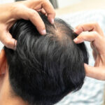 Hair Loss Treatment in Riyadh for Restoring Hair Vitality and Confidence