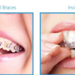 Clear Aligners Cost Philippines: A Complete Guide to Achieving a Straighter Smile 3 Clear Aligners Cost Philippines: A Complete Guide to Achieving a Straighter Smile