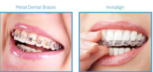 Clear Aligners Cost Philippines: A Complete Guide to Achieving a Straighter Smile