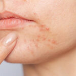 Acne Scar Treatment in Riyadh 17