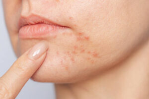How Modern Acne Scar Treatment Supports Skin Renewal